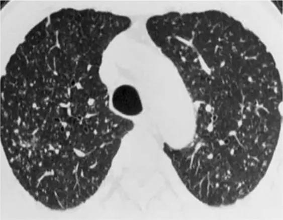 间质性肺疾病看病经验分享,分享肺腺癌临床实验的例子