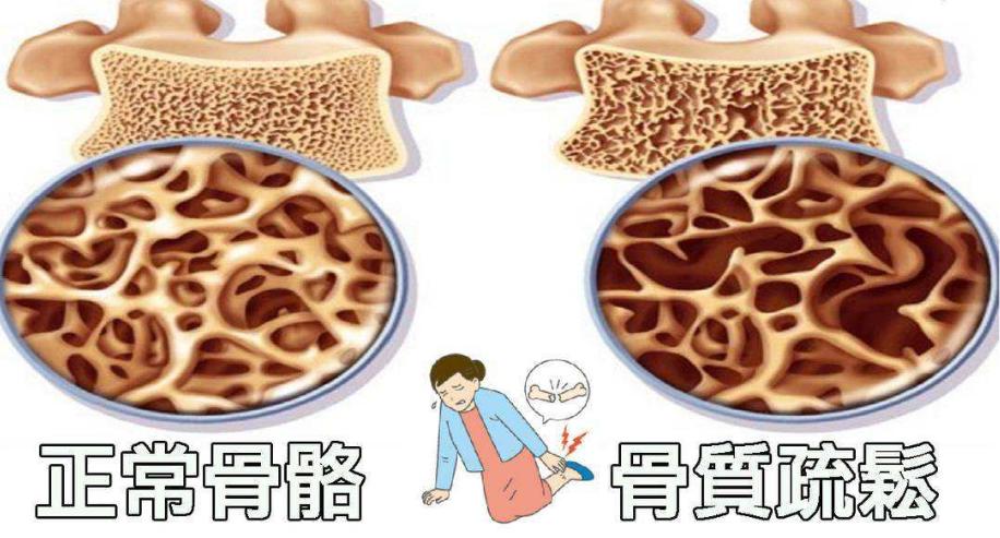 治疗骨质疏松的首选药西药,专治老年骨质疏松药