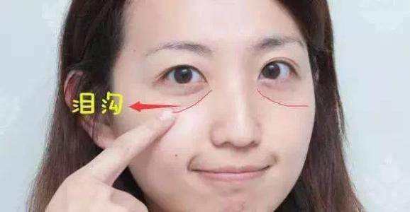 如何消除泪沟最有效的方法,泪沟怎么快速消除
