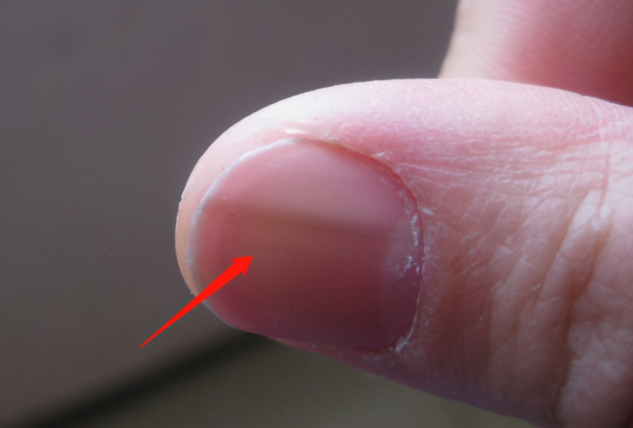 十岁孩子指甲上有竖纹是怎么回事,指甲出现竖条纹还会裂开