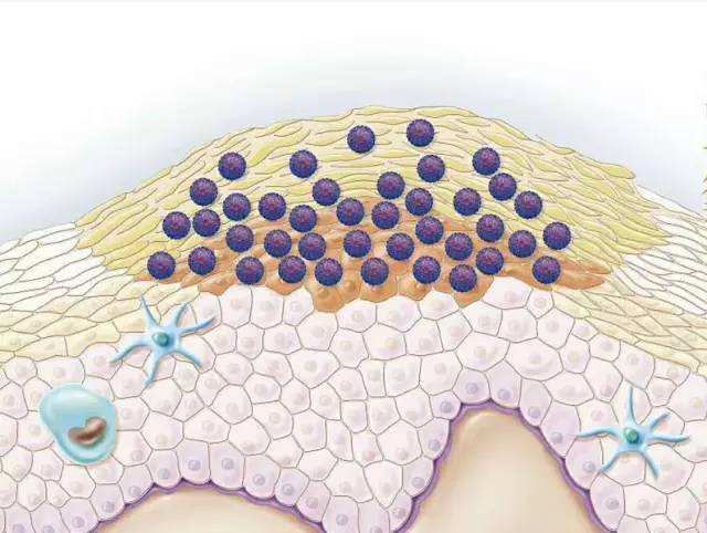尖锐湿疣到底是啥,尖锐性湿疣早期辨识