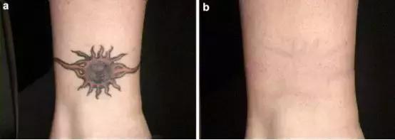 纹身的激光治疗,激光能祛纹身吗