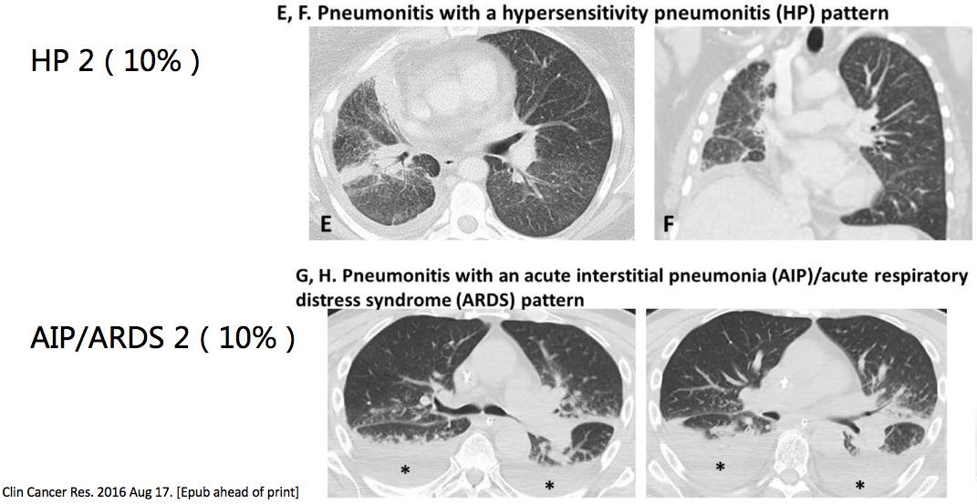 王孟昭看肺癌怎么样,王孟昭大细胞肺癌