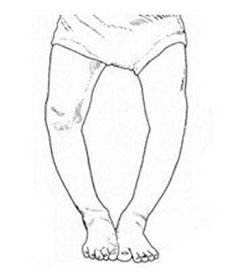 o型腿怎么拯救,o型腿不要做哪些动作