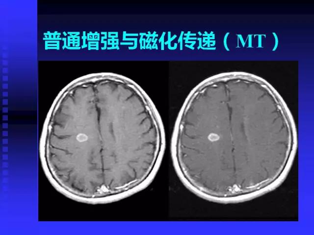 头颅mri读片视频教程,颅脑mri读片入门教程视频讲解全集