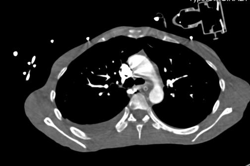 消化道出血高钾血症治疗,诊断高碳酸血症的金标准是什么