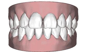 为什么牙齿矫正医生建议拔牙,牙齿矫正医生说要拔牙有的说不拔