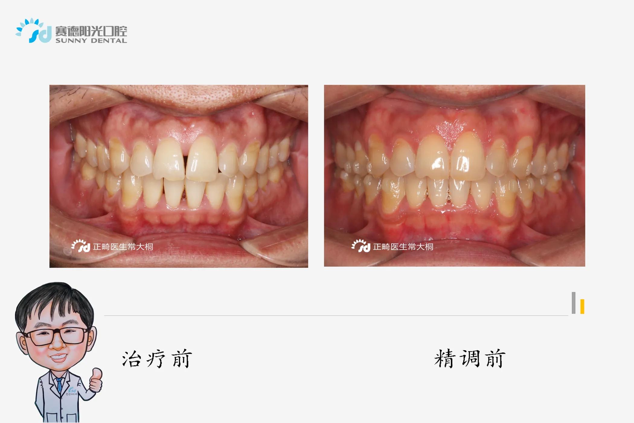 隐适美正畸牙拔掉不美观怎么办,隐适美黑三角什么时候会出现