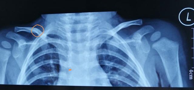 儿童高处坠落多久出现症状,孩子高处坠落摔到头会有什么反应