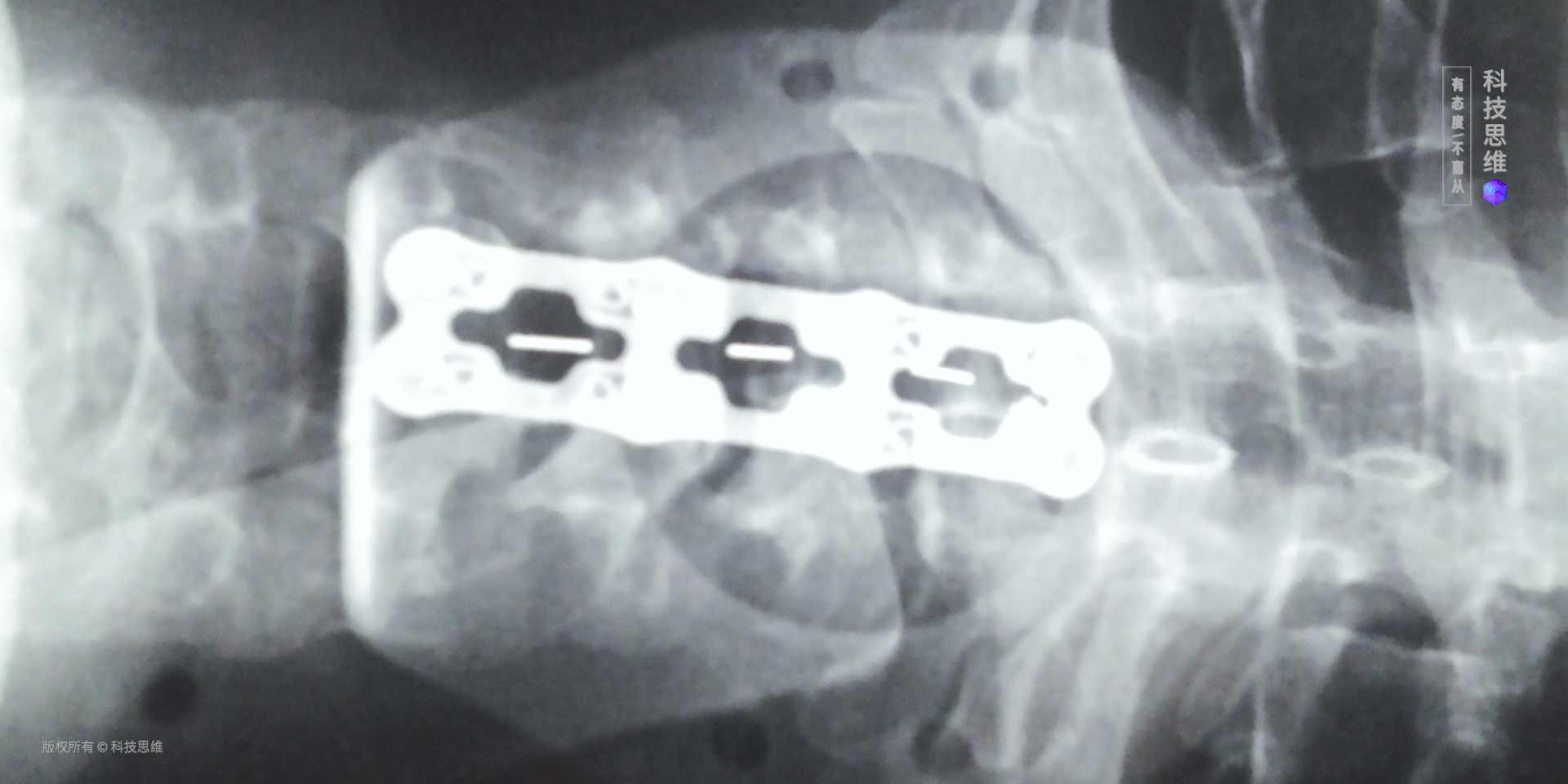 医生告诉我要配合颈椎病的治疗，于是我买了这把人体工学椅，挺好