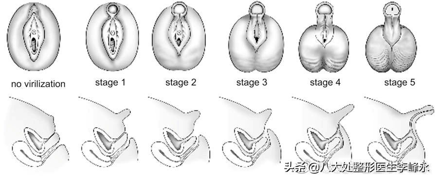 假性两性畸形是怎样形成的,性分化与发育异常