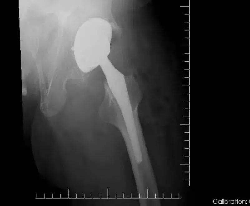 髋关节疼痛自愈的最佳方法,髋关节疼痛走路一瘸一拐