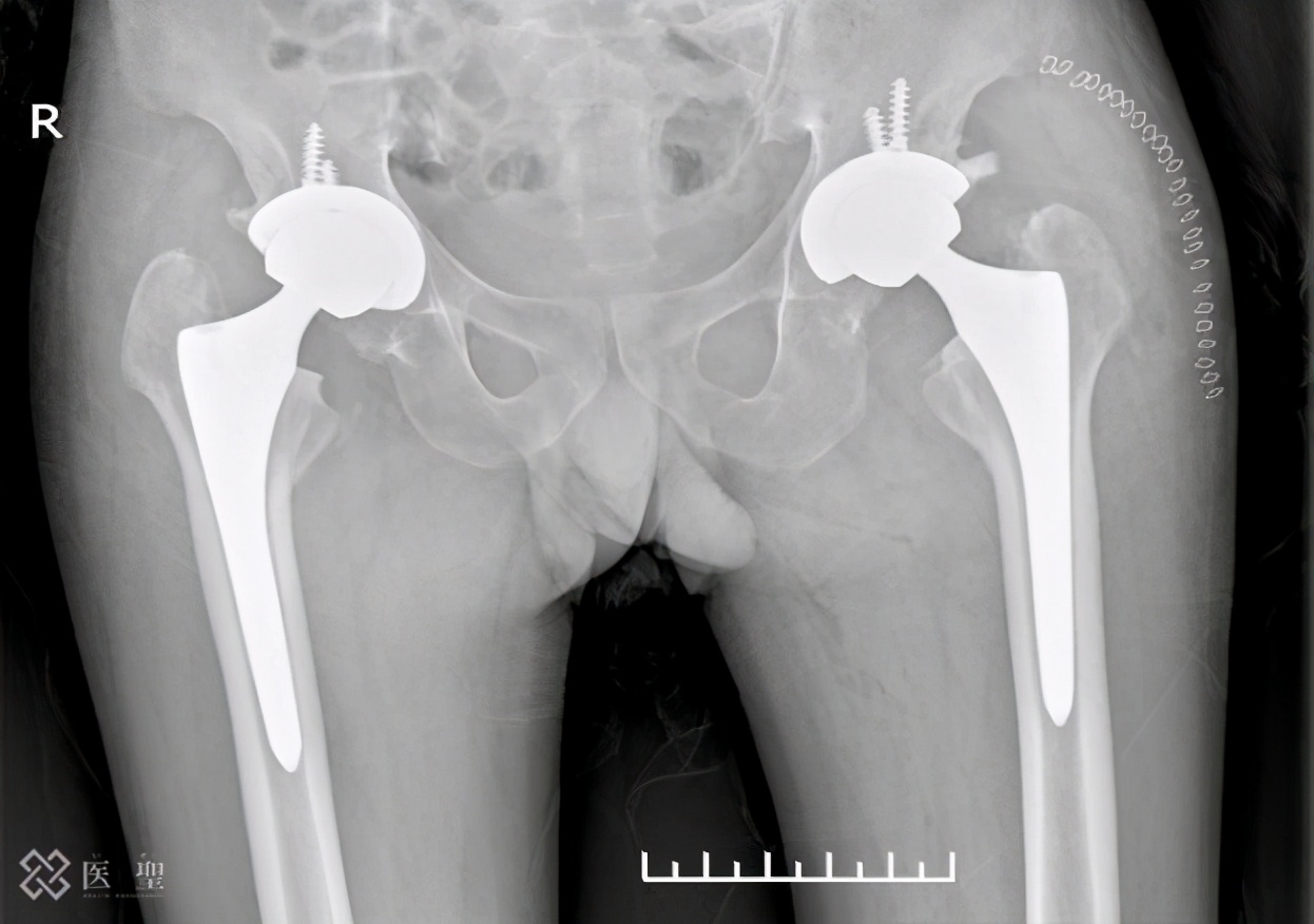 干细胞回输能治疗股骨头坏死吗,造血干细胞治疗股骨头坏死