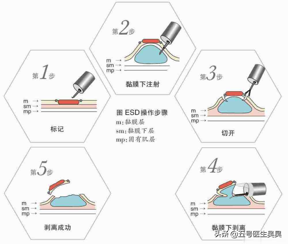 肠道长了息肉怎么办,肠道里的息肉需要处理吗
