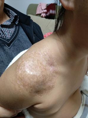 女婴右肩斑块连结混合型血管瘤生长迅速