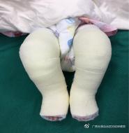 马蹄内翻足孩子的康复,成人马蹄足内翻康复治疗