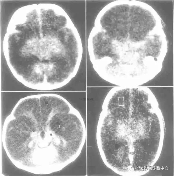 颅脑核磁影像解剖图谱,颅脑mr增强影像图片