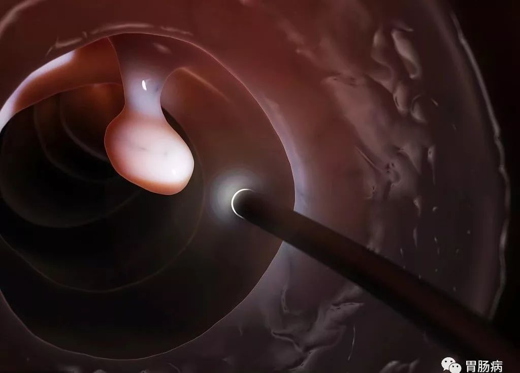 肠息肉切除后3年得肠癌,女性肠息肉切除多久可以恢复