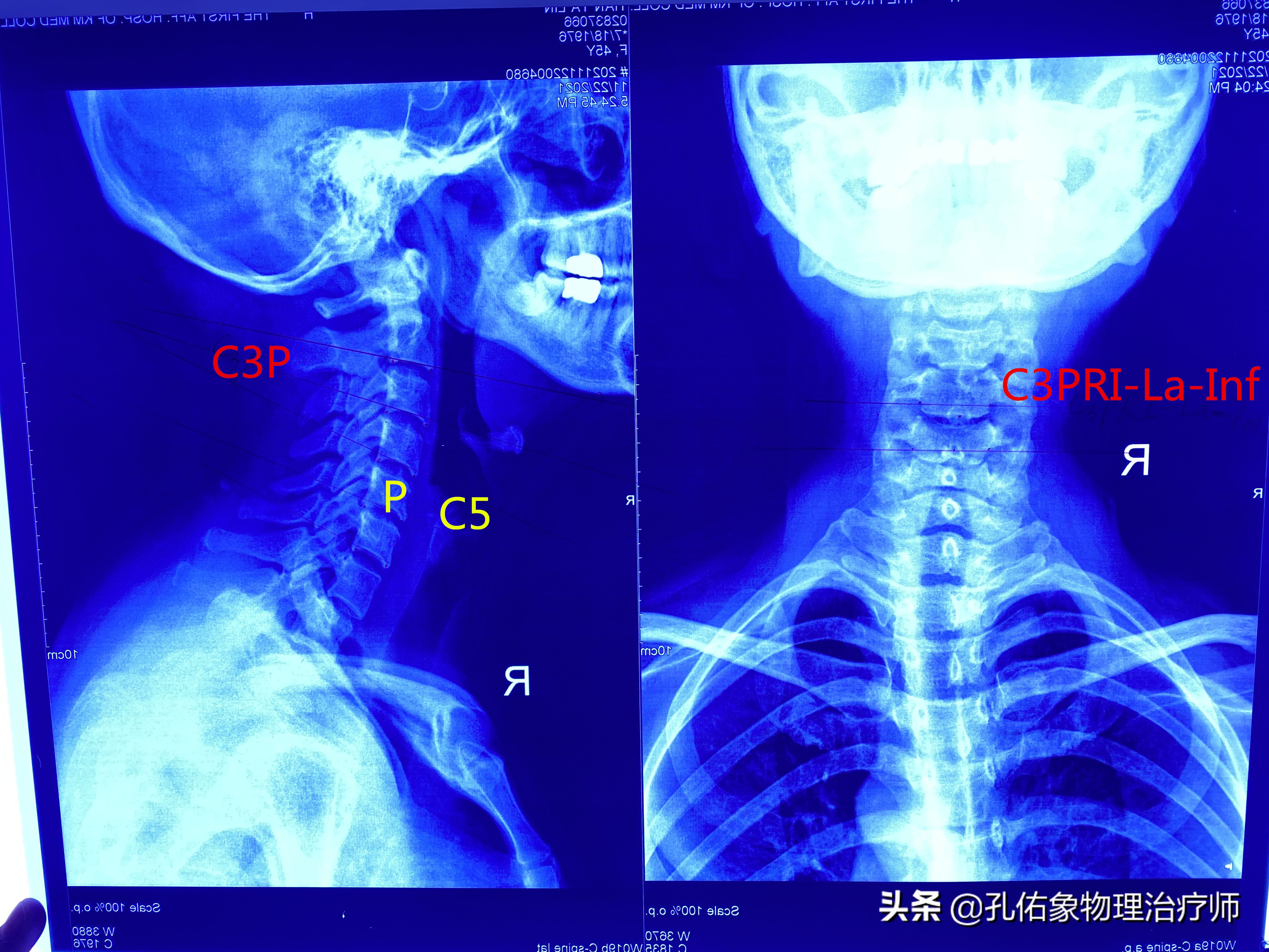 左肩膀和肩胛骨内侧肌肉会疼,右肩膀肩胛骨疼痛怎么快速缓解