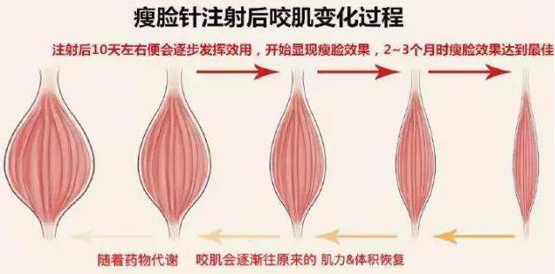 瘦脸针瘦脸详细讲解,瘦脸针瘦脸详细讲解图