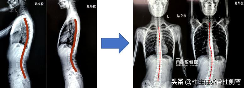 儿童脊柱侧弯单杠矫正正确姿势,脊柱侧弯拉单杠好还是吊单杠好