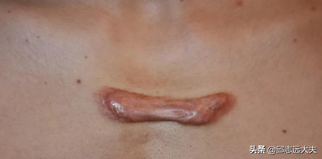 小孩伤口怎么不留疤,伤口怎么不留疤快速恢复