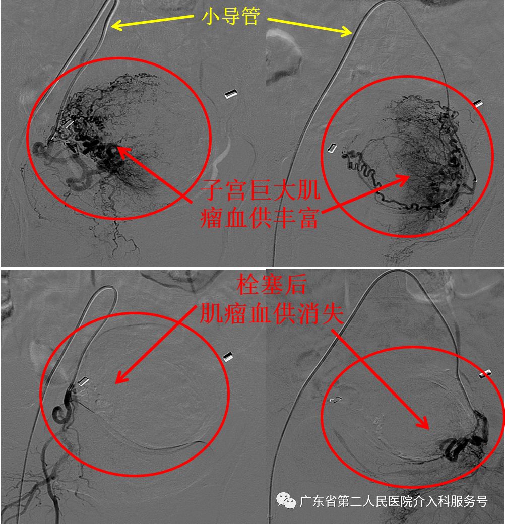针眼妙方治疗，1个月后让淋沥不净的“大姨妈”如期结束