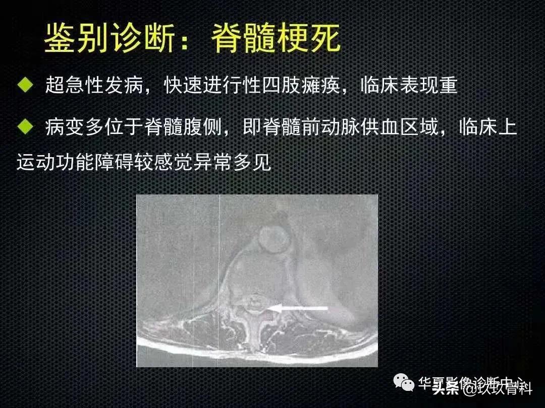 颈椎病脊髓变性mri表现,脊髓亚急性联合变性的诊断