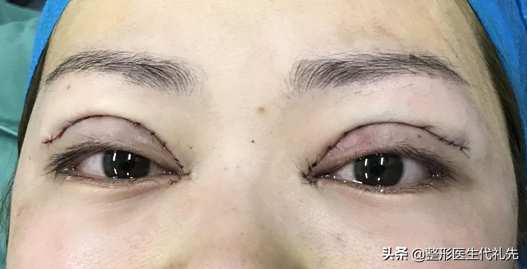 新月双眼皮怎样改扇形,聊双眼皮话术