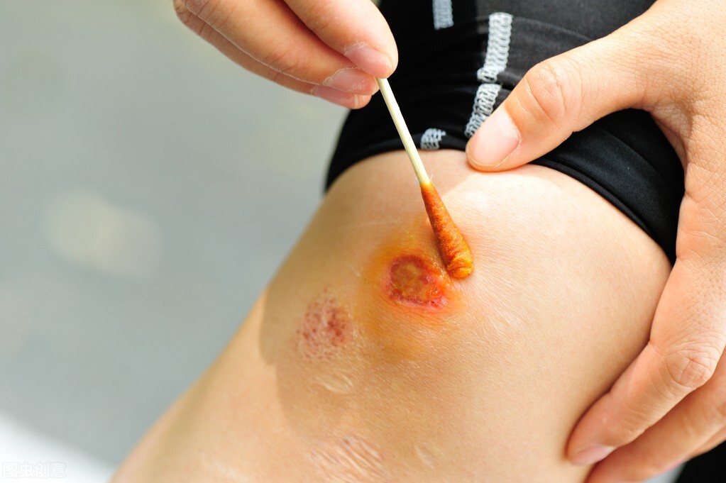 伤口碘伏消毒抹紫药水行吗,皮肤消毒用碘伏好还是酒精好