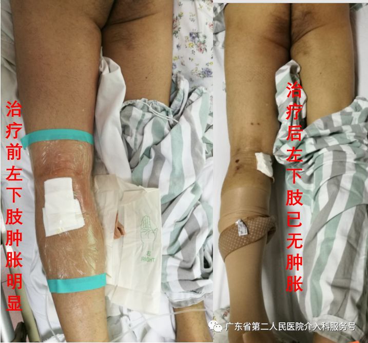 左腿血栓的最快消除方法,左腿浮肿有血栓用什么药治疗