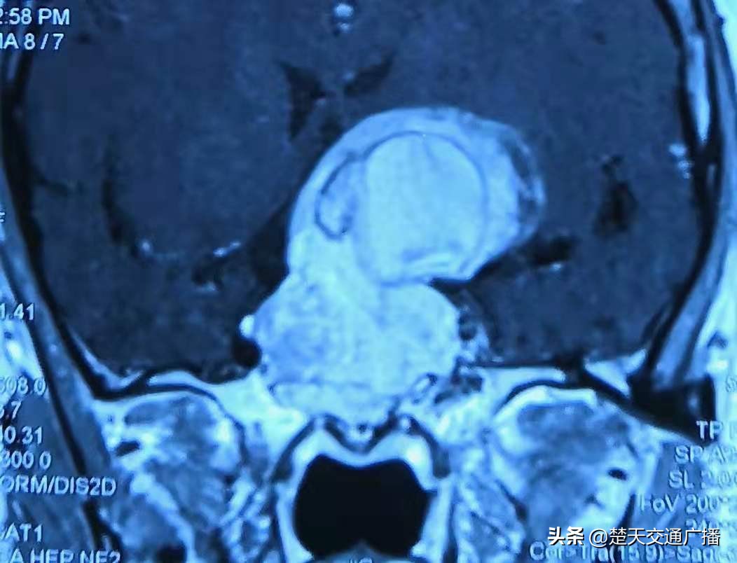 57岁女人视力下降该咋办,脑部有肿瘤视力模糊是什么肿瘤