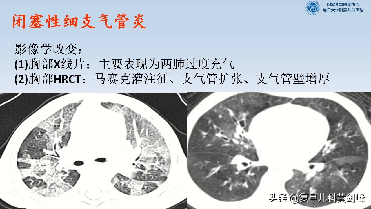 孩子喘是什么原因,孩子一感冒就喘是什么原因