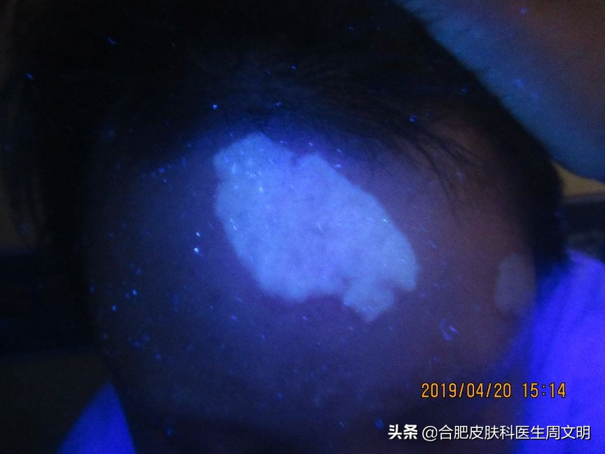 15岁女生误诊,15岁女孩染病竟有4年病史