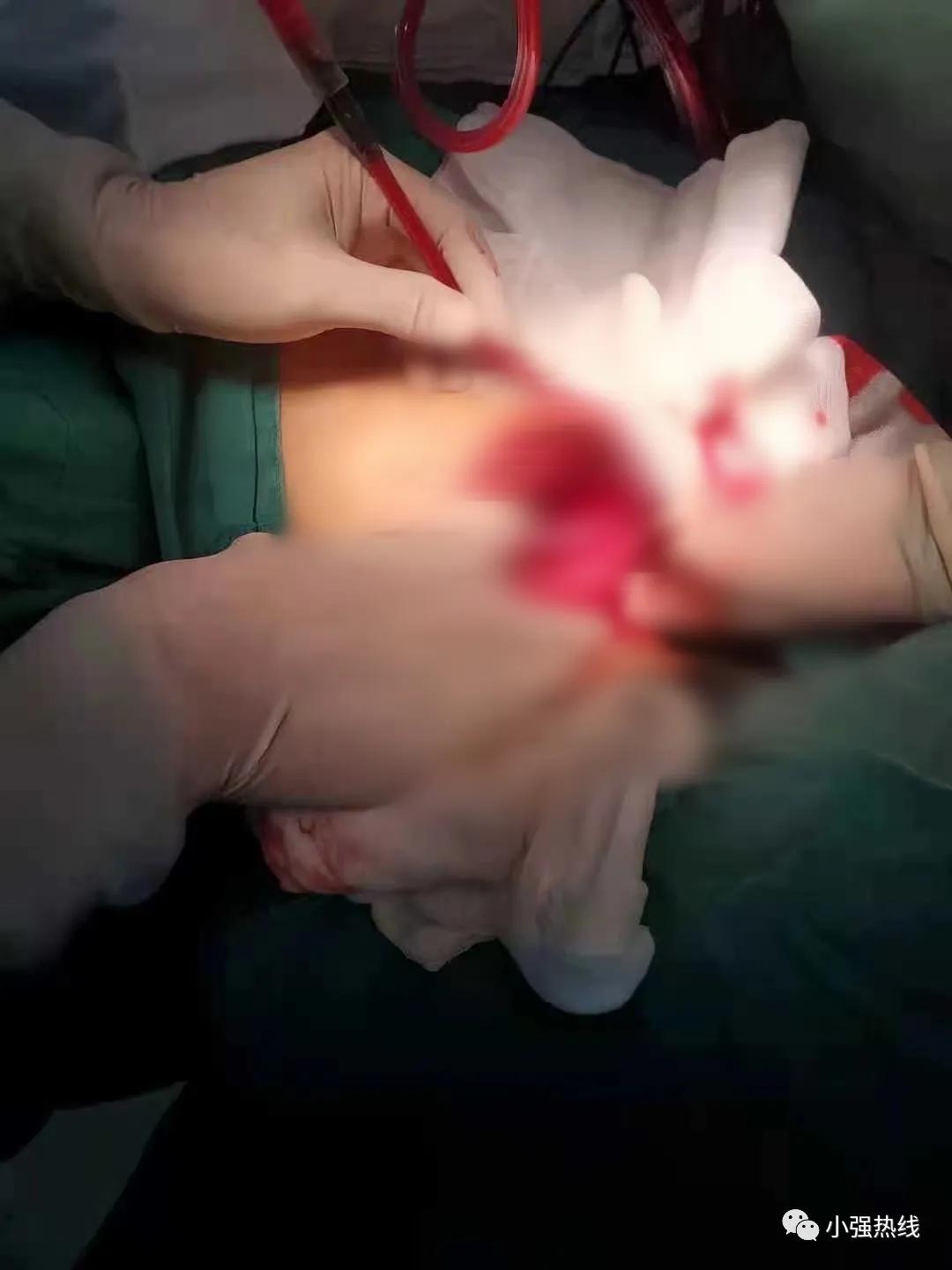 太狠了一剑刺穿心爱的人,小伙胸口被刀捅人事件