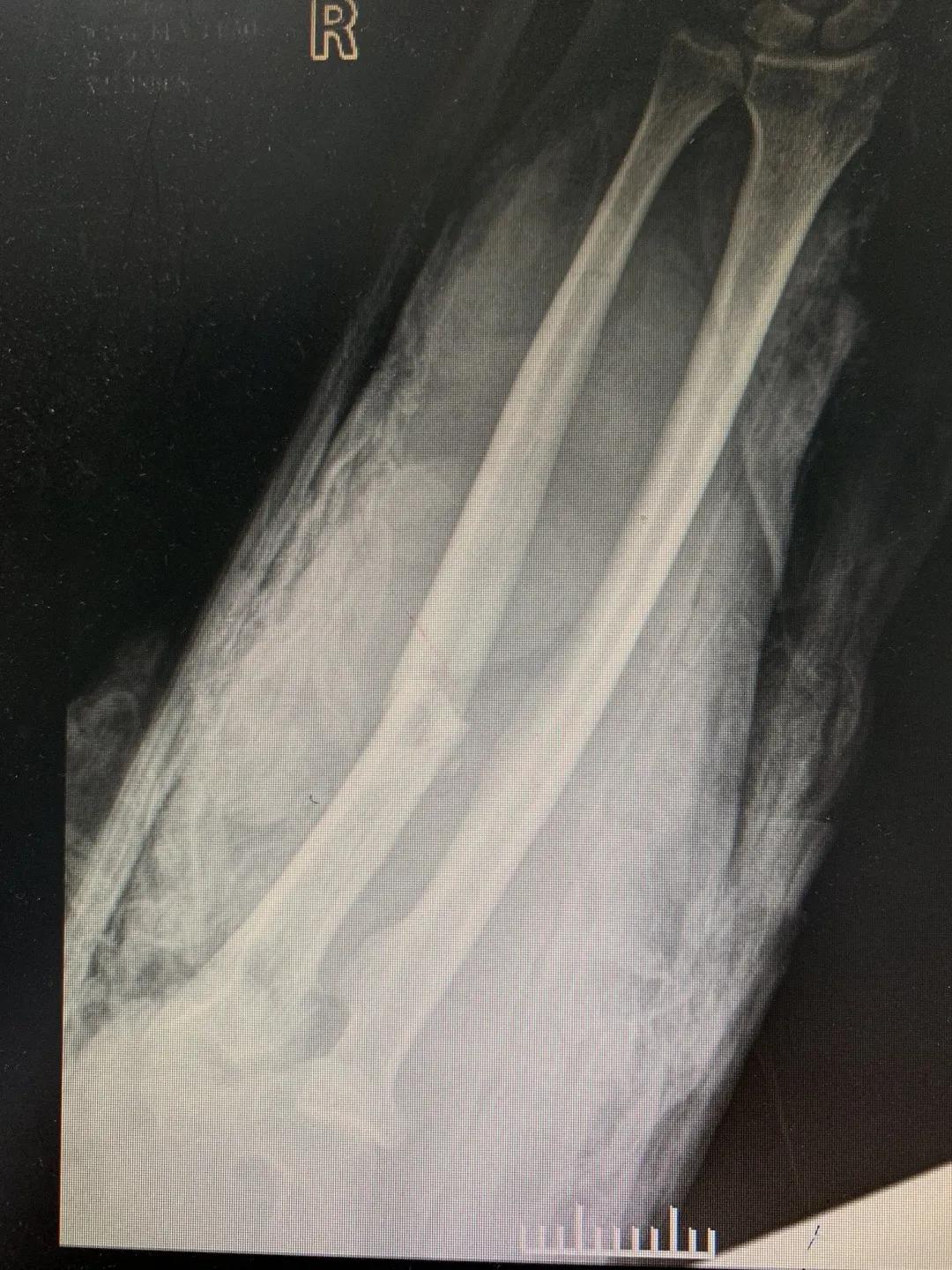 【日照市人民医院】右臂卷入机器被撕裂　6.5小时成功复活