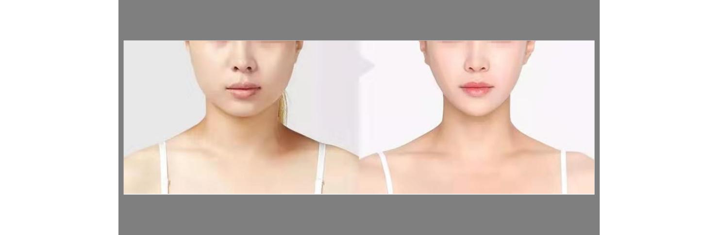 热玛吉抗衰技术可靠吗,超声炮和热玛吉哪个抗衰效果好