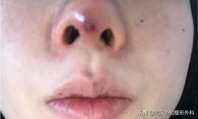 为什么不建议做线雕隆鼻手术,为什么不建议做线雕隆鼻