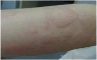 幼儿麻疹出疹子后禁忌,小儿疹子和麻疹的区别