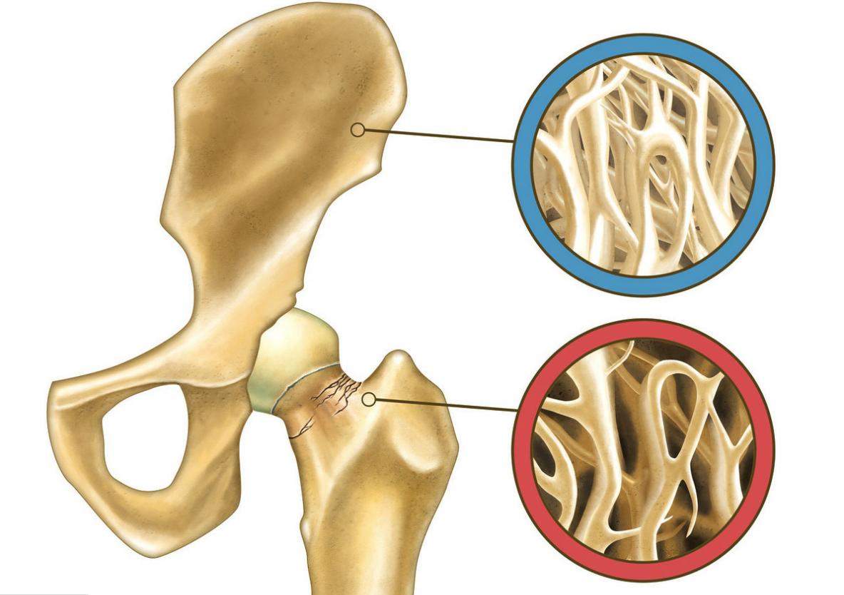 特立帕肽目前多少钱一针,特立帕肽促进骨愈合吗