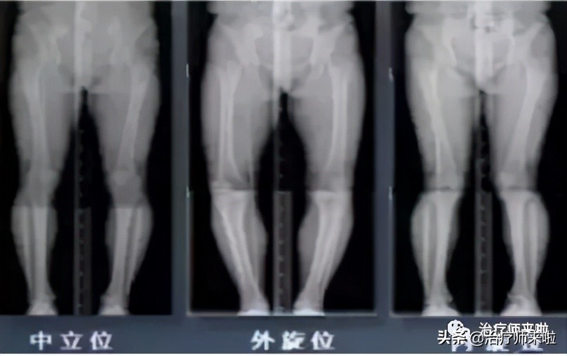 怎么让腿型改正,怎样使腿型变直