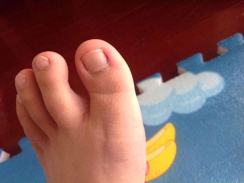 甲沟炎剪指甲的正确方式,甲沟炎剪指甲的正确方法