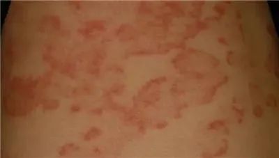 夏日如何远离体癣、花斑癣、股癣等各种皮肤癣的困扰