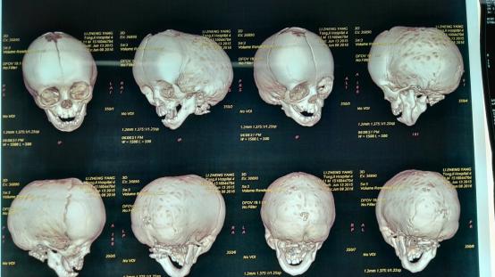 孩子的头偏小怎么办,孩子扁头偏头