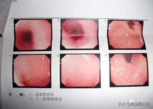 慢性浅表性胃炎怎样治更有效,慢性浅表性胃炎是根本就治不好吗