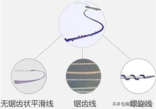 脸上做完埋线多久起效果,做完埋线为什么脸上有坑