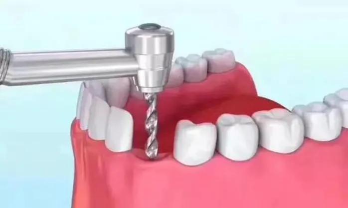 种植牙手术流程图解,口腔种植牙护士手术配台流程