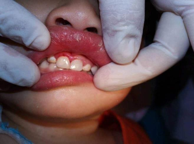 宝宝的乳牙掉了怎么处理,乳牙掉了不要扔关键时刻能救命