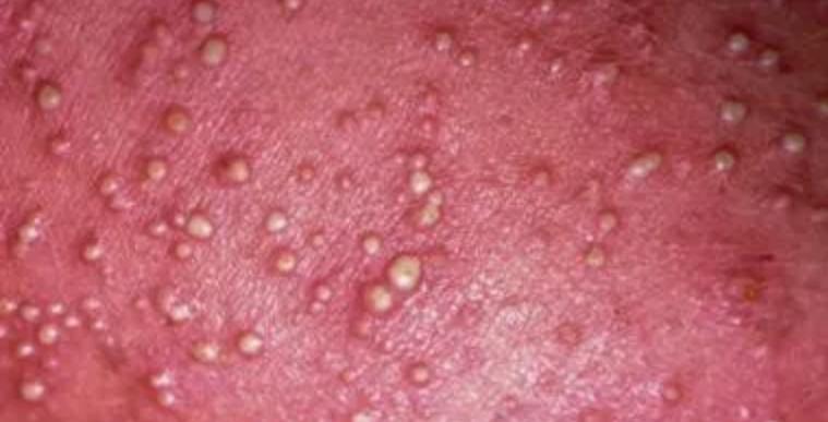 汗疱疹湿疹痱子的皮肤护理,汗疱疹和痱子怎么治