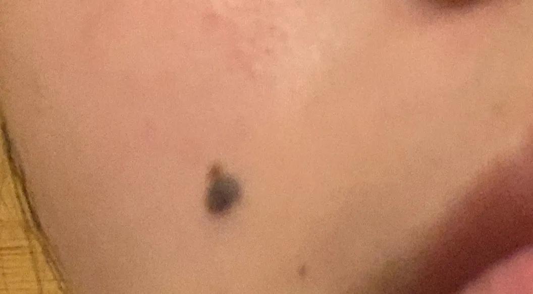 耳朵切痣恢复图片,切痣手术后恢复过程图